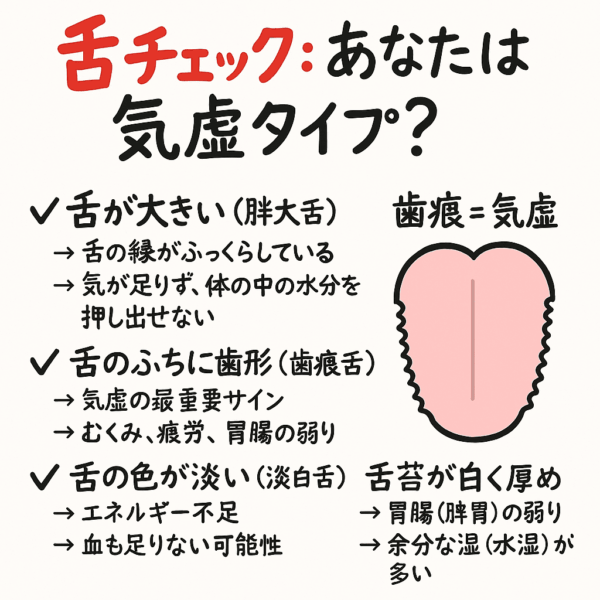 子宮内膜症や生理痛の原因となる体質“気虚”を舌でチェックする図解。肥大舌、歯痕舌、淡白舌、白い舌苔などの特徴を示し、気虚による疲労・むくみ・胃腸の弱りが月経痛や下腹部症状につながることを説明したイラスト。