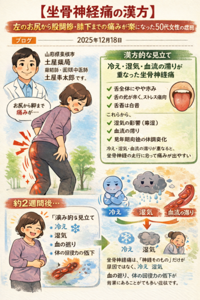 冷え・湿気・血流の滞り、更年期前後の体調変化が重なって起こる坐骨神経痛を、舌診と体質の観点から解説した漢方イラスト