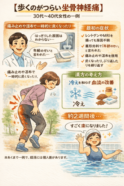 歩くのがつらい坐骨神経痛に悩む30〜40代女性の症例をもとに、冷えや血流の滞りから漢方的に考えた相談の流れと、生活が楽になった経過を手書き風イラストで表現した図
