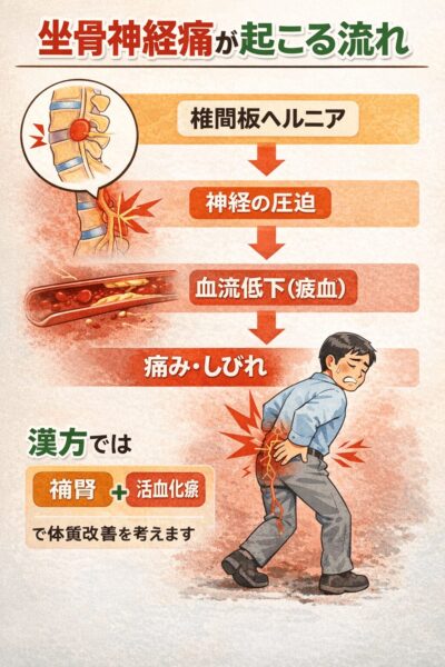 坐骨神経痛が起こる仕組みの図｜椎間板ヘルニアによる神経圧迫と血流低下（瘀血）によってお尻から足の痛みやしびれが起こる流れ